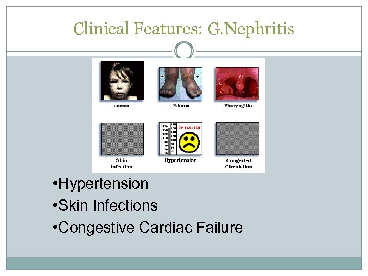 Clinical Features: G. Nephritis • Hypertension • Skin Infections • Congestive Cardiac Failure 