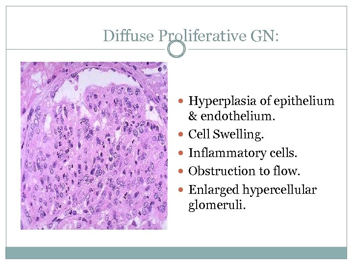 Diffuse Proliferative GN: Hyperplasia of epithelium & endothelium. Cell Swelling. Inflammatory cells. Obstruction to