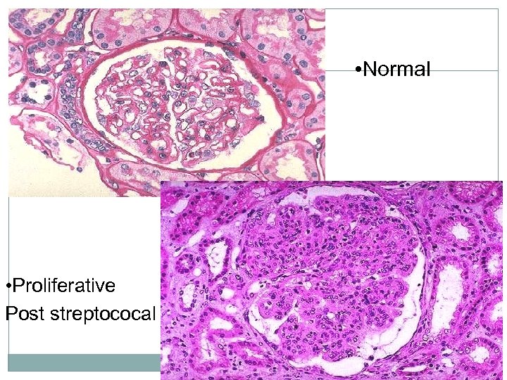  • Normal • Proliferative Post streptococal 