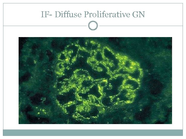 IF- Diffuse Proliferative GN 