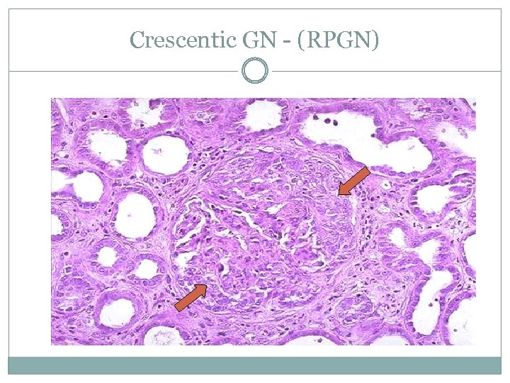 Crescentic GN - (RPGN) 