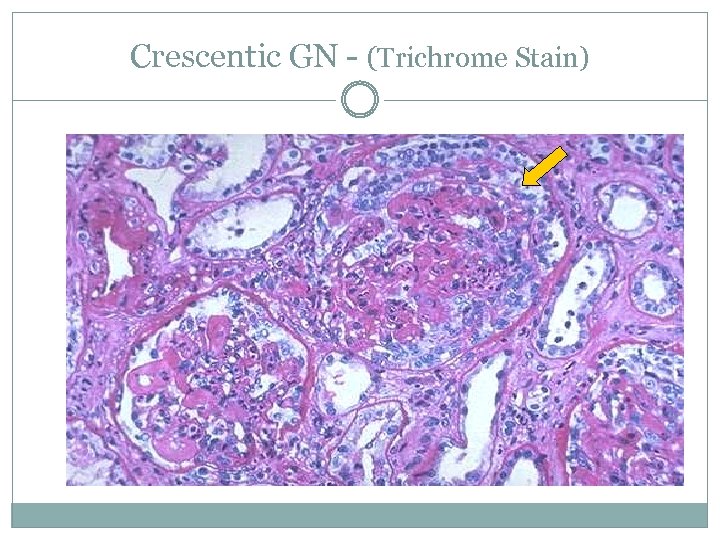 Crescentic GN - (Trichrome Stain) 