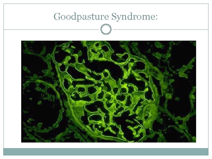 Goodpasture Syndrome: 