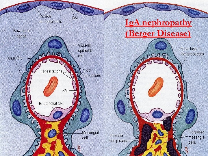 Ig. A nephropathy (Berger Disease) 