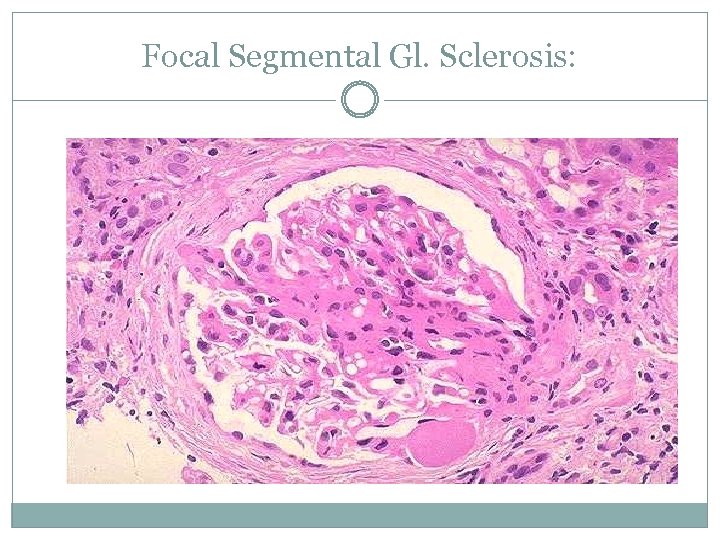 Focal Segmental Gl. Sclerosis: 