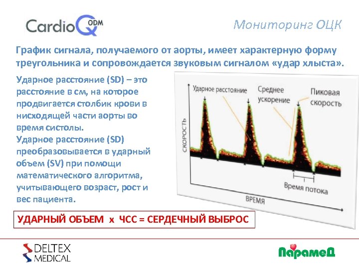 Мониторинг ОЦК График сигнала, получаемого от аорты, имеет характерную форму треугольника и сопровождается звуковым