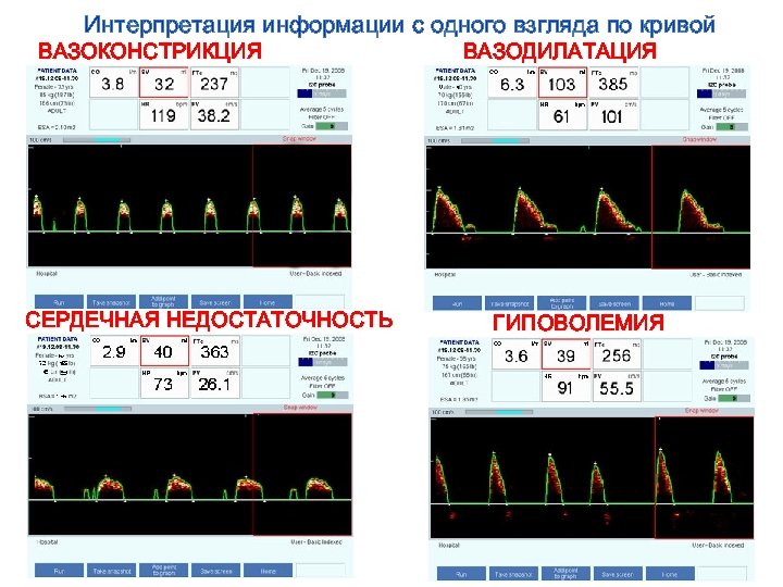 Интерпретация информации с одного взгляда по кривой ВАЗОКОНСТРИКЦИЯ СЕРДЕЧНАЯ НЕДОСТАТОЧНОСТЬ ВАЗОДИЛАТАЦИЯ ГИПОВОЛЕМИЯ 