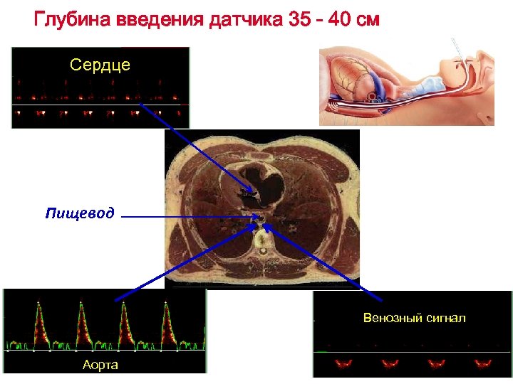 Глубина введения датчика 35 - 40 см Сердце Пищевод Венозный сигнал Аорта 