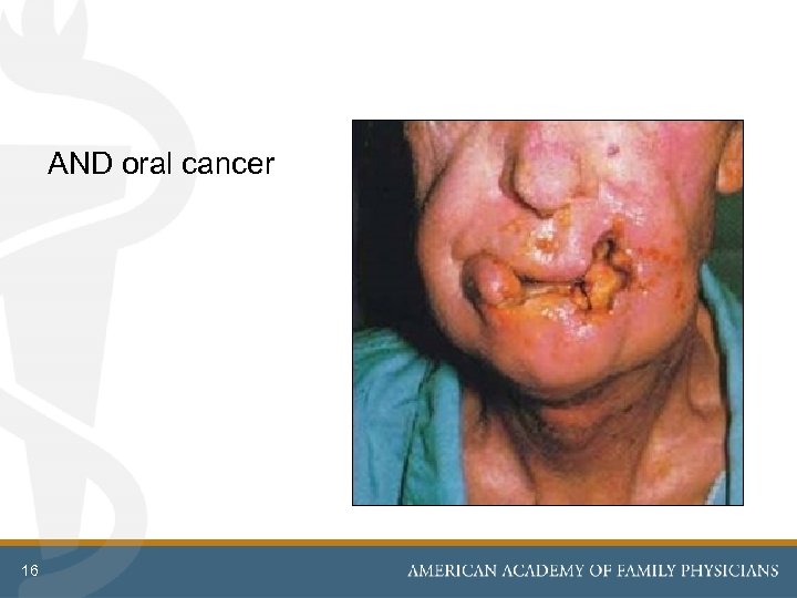 AND oral cancer 16 