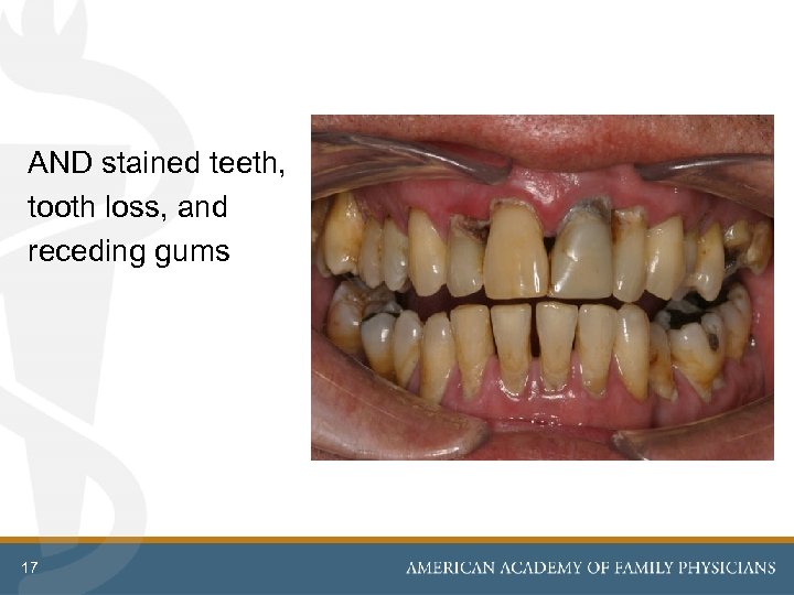 AND stained teeth, tooth loss, and receding gums 17 