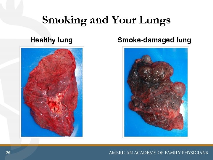 Smoking and Your Lungs Healthy lung 26 Smoke-damaged lung 
