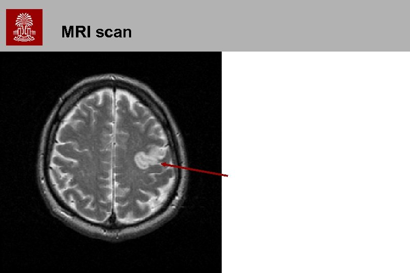 MRI scan 