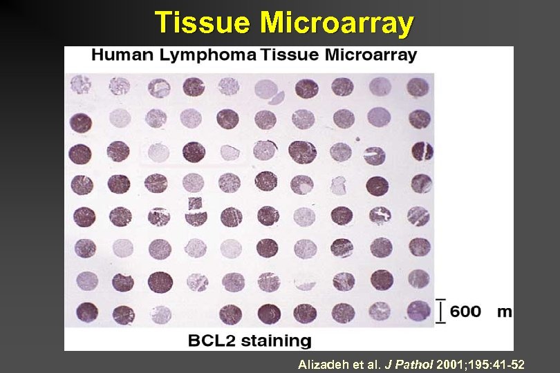 Tissue Microarray Alizadeh et al. J Pathol 2001; 195: 41 -52 