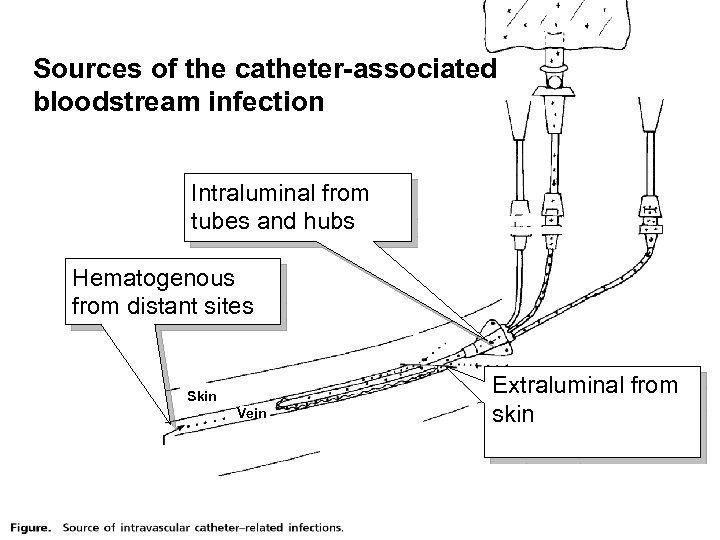Sources of the catheter-associated bloodstream infection Intraluminal from tubes and hubs Hematogenous from distant