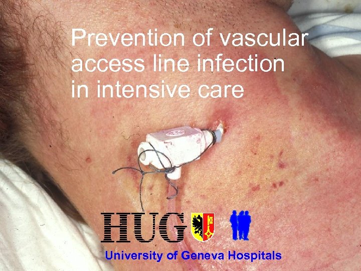 Prevention of vascular access line infection in intensive care University of Geneva Hospitals 