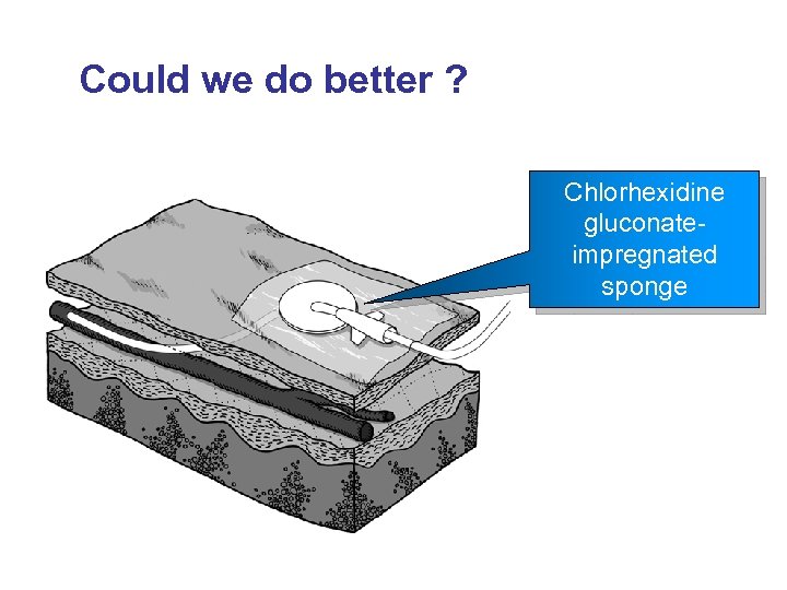 Could we do better ? Chlorhexidine gluconateimpregnated sponge 