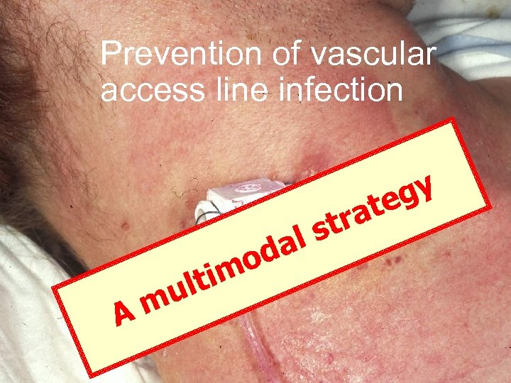 Prevention of vascular access line infection al od m A tim ul ra st