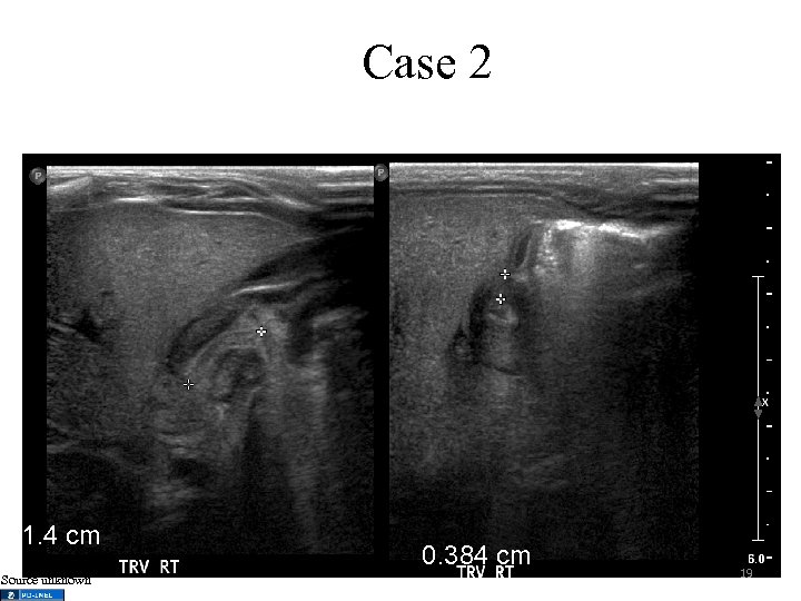 Case 2 1. 4 cm Source unknown 0. 384 cm 19 