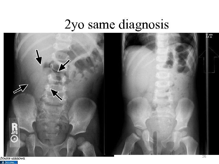 2 yo same diagnosis Source unknown 26 