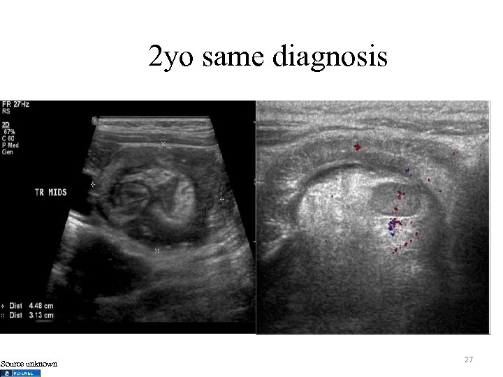 2 yo same diagnosis Source unknown 27 