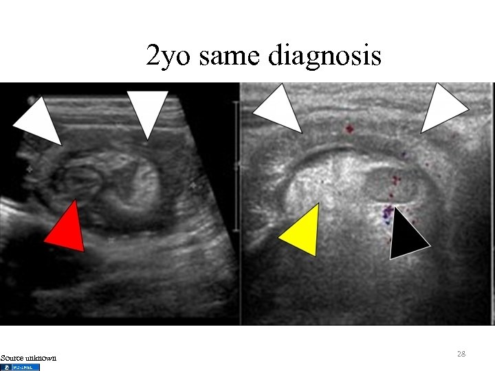 2 yo same diagnosis Source unknown 28 