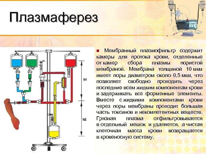 Плазмаферез Мембранный плазмофильтр содержит камеры для протока крови, отделенные от камер сбора плазмы пористой