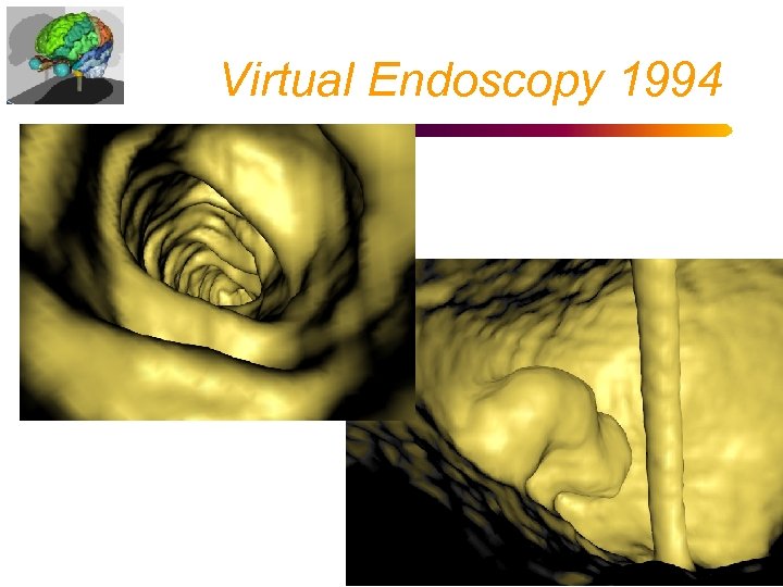 Virtual Endoscopy 1994 