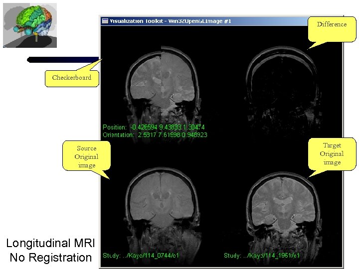 Difference Checkerboard Source Original image Longitudinal MRI No Registration Target Original image 
