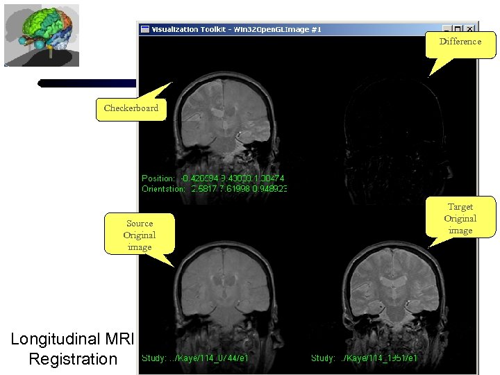 Difference Checkerboard Source Original image Longitudinal MRI Registration Target Original image 