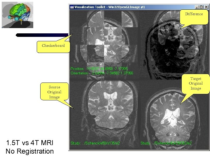 Difference Checkerboard Source Original Image 1. 5 T vs 4 T MRI No Registration