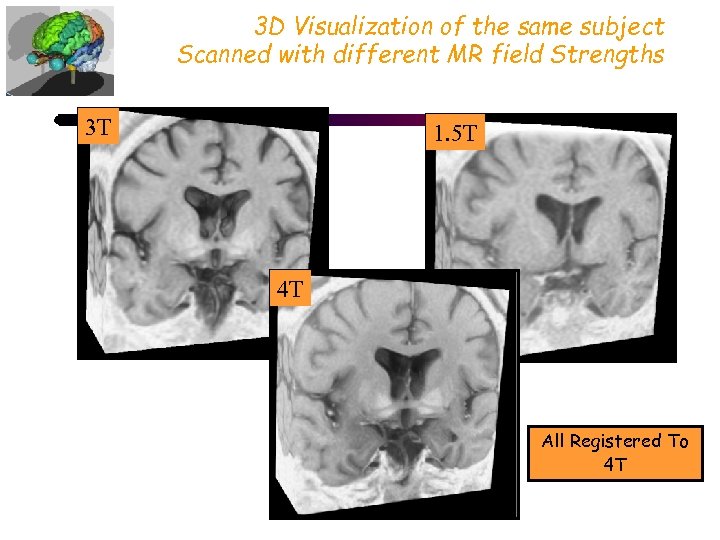 3 D Visualization of the same subject Scanned with different MR field Strengths 3