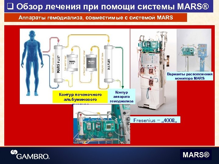 q Обзор лечения при помощи системы MARS® Аппараты гемодиализа, совместимые с системой MARS Варианты