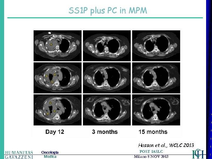 SS 1 P plus PC in MPM Hassan et al. , WCLC 2013 Oncologia