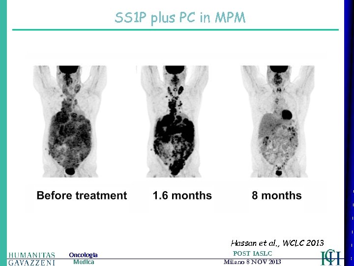 SS 1 P plus PC in MPM Hassan et al. , WCLC 2013 Oncologia