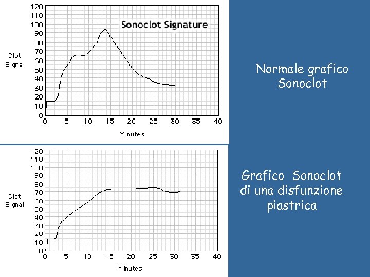 Normale grafico Sonoclot Grafico Sonoclot di una disfunzione piastrica 