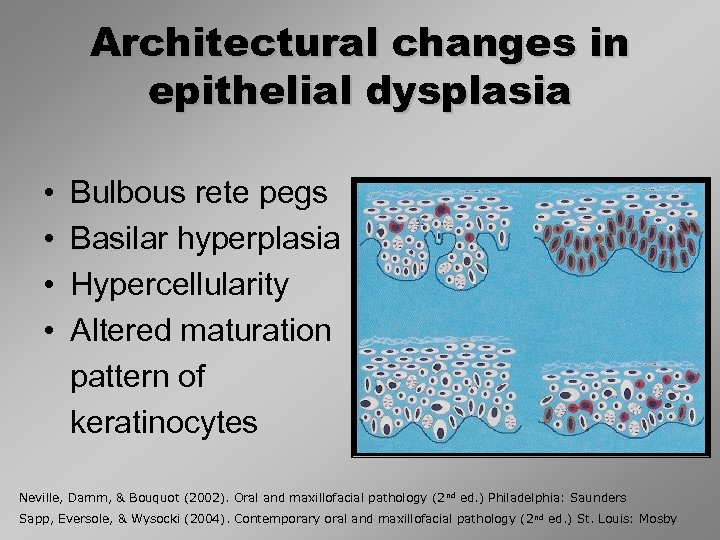 Architectural changes in epithelial dysplasia • • Bulbous rete pegs Basilar hyperplasia Hypercellularity Altered