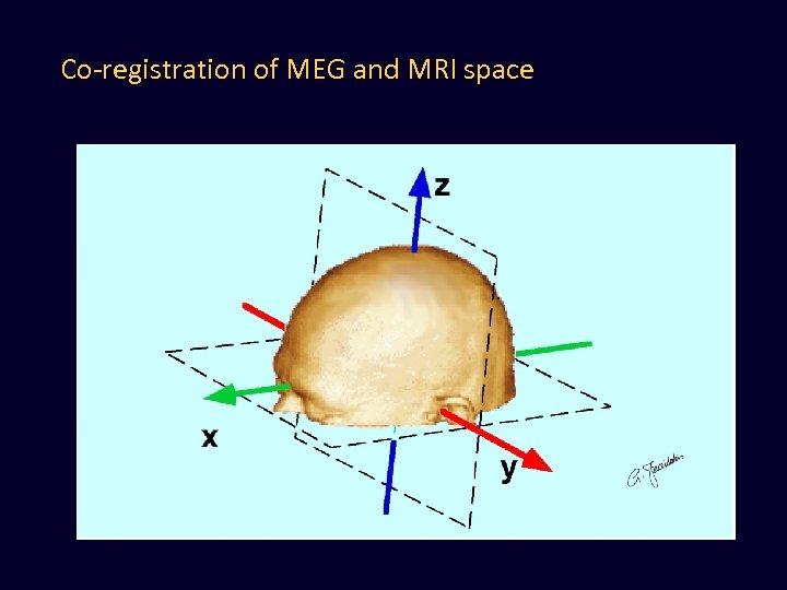 Co-registration of MEG and MRI space 