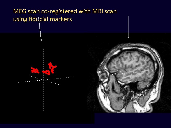 MEG scan co-registered with MRI scan using fiducial markers 