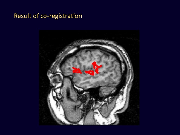 Result of co-registration 