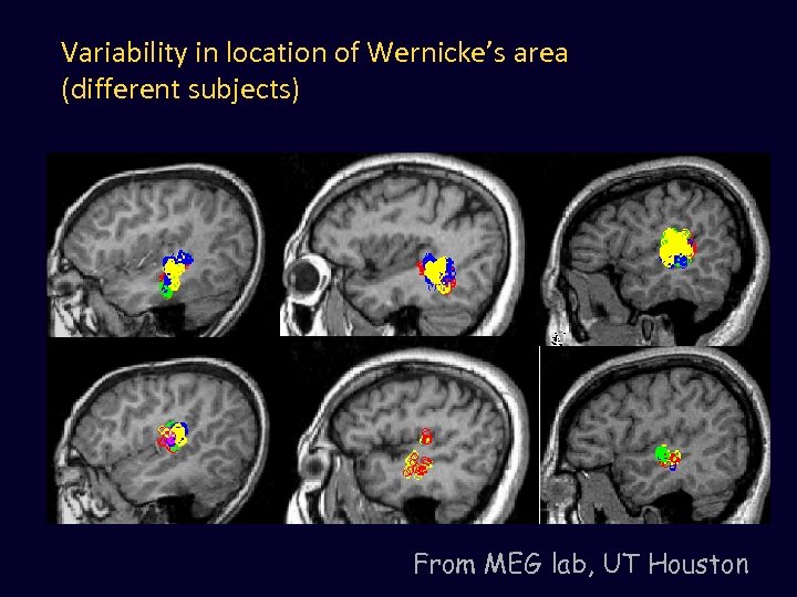 Variability in location of Wernicke’s area (different subjects) From MEG lab, UT Houston 