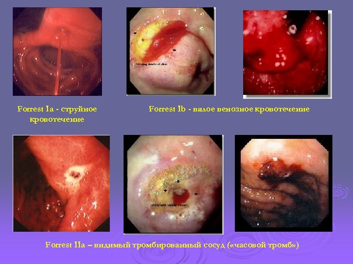 Forrest Ia - струйное кровотечение Forrest Ib - вялое венозное кровотечение Forrest IIa –