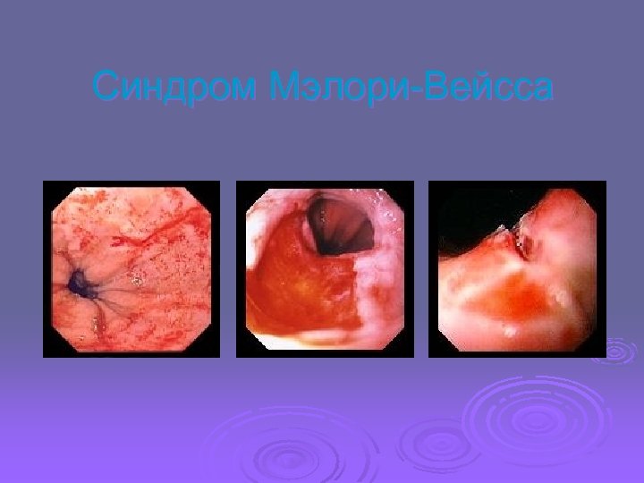 Синдром Мэлори-Вейсса 