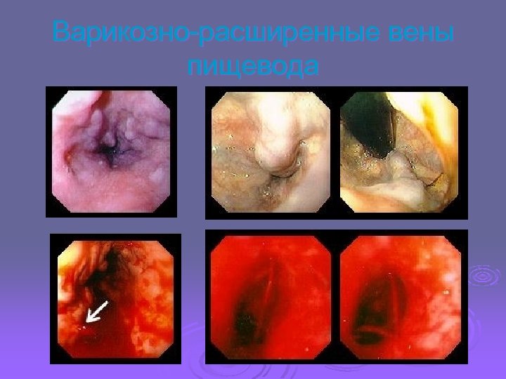 Варикозно-расширенные вены пищевода 