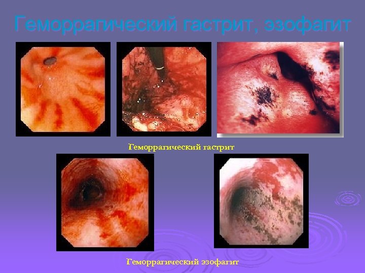 Геморрагический гастрит, эзофагит Геморрагический гастрит Геморрагический эзофагит 