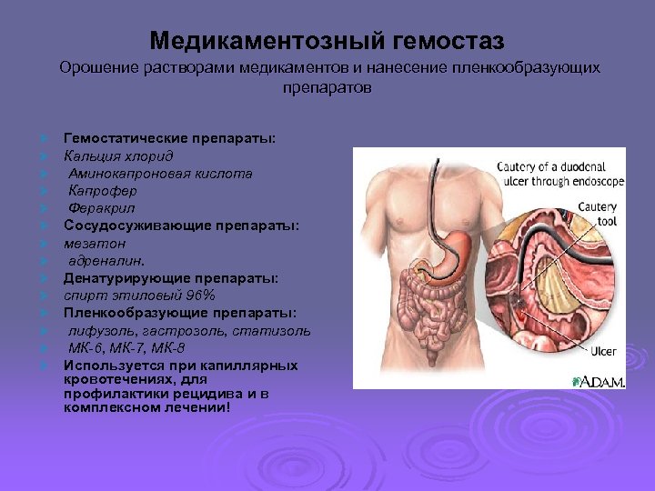 Медикаментозный гемостаз Орошение растворами медикаментов и нанесение пленкообразующих препаратов Ø Ø Ø Ø Гемостатические