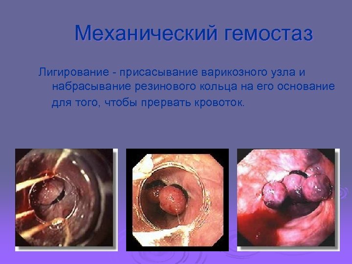 Механический гемостаз Лигирование - присасывание варикозного узла и набрасывание резинового кольца на его основание