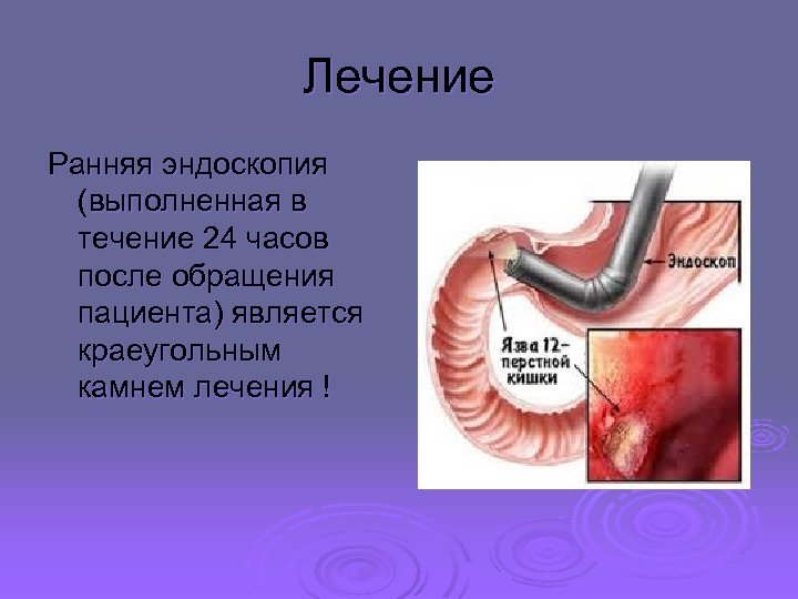 Лечение Ранняя эндоскопия (выполненная в течение 24 часов после обращения пациента) является краеугольным камнем
