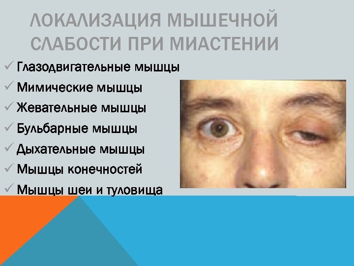 ЛОКАЛИЗАЦИЯ МЫШЕЧНОЙ СЛАБОСТИ ПРИ МИАСТЕНИИ ü Глазодвигательные мышцы ü Мимические мышцы ü Жевательные мышцы