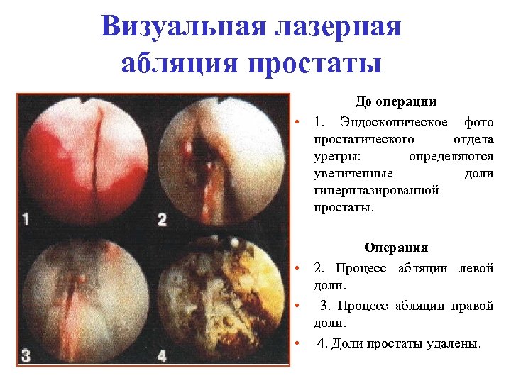 Визуальная лазерная абляция простаты До операции • 1. Эндоскопическое фото простатического отдела уретры: определяются