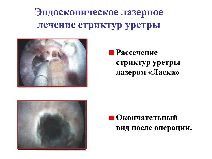 Эндоскопическое лазерное лечение стриктур уретры Рассечение стриктур уретры лазером «Ласка» Окончательный вид после операции.